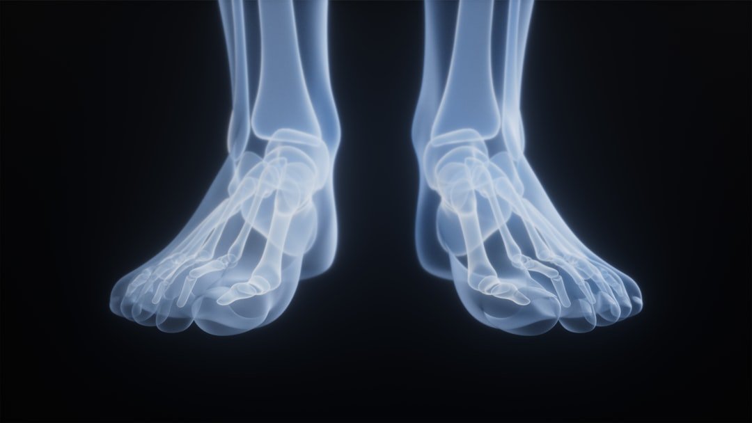 neuroma di morton - Guida completa Ri-Hub teleriabilitazione